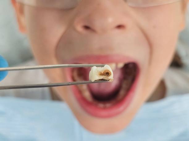 Best Emergency Wisdom Teeth Removal in Ellwood City, PA